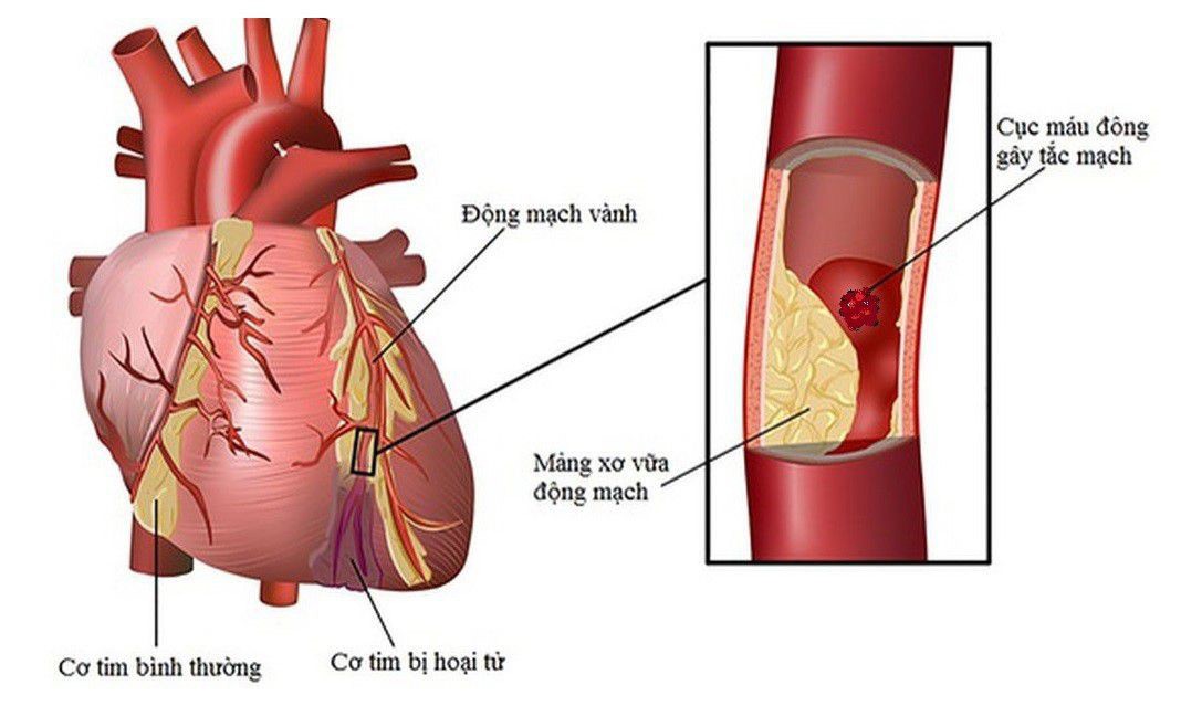 5 biện pháp giảm nguy cơ biến cố tim mạch khi thời tiết lạnh- Ảnh 1.